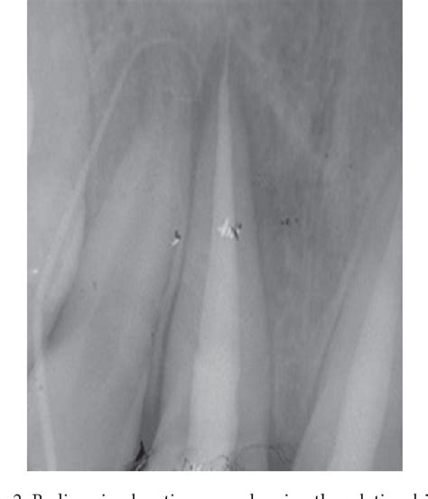 Figure 1 From Diagnosis And Managment Of Maxillary Incisor With Vertical Root Fracture A