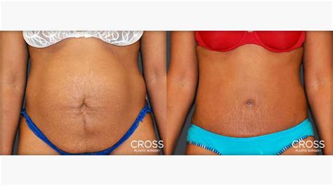 Tummy Tuck Belly Button With Scar Camerafery