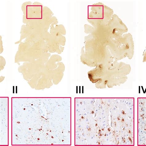 Quantification Of Tau At Histopathology In Cte A P Tau Pathology Was