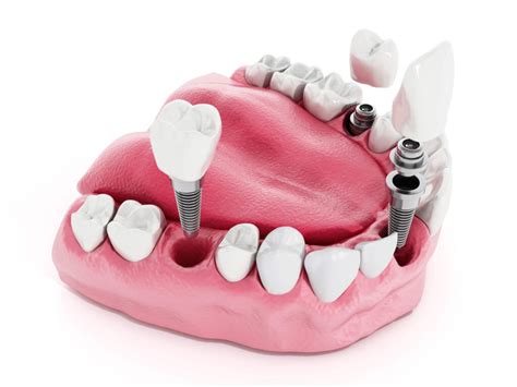 What Are The Factors Affecting The Cost Of Dental Implants Center For Implant Dentistry