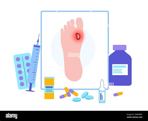 Diabetic Foot Ulcers Illustration Stock Photo Alamy