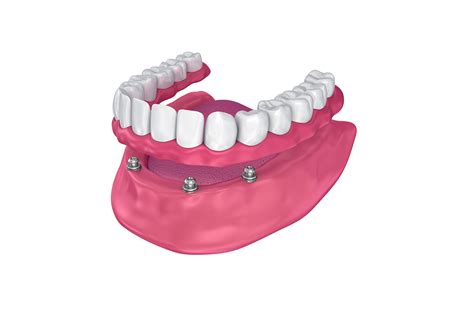 Top Implant Overdentures In Coral Gables Miami South Gables Dental