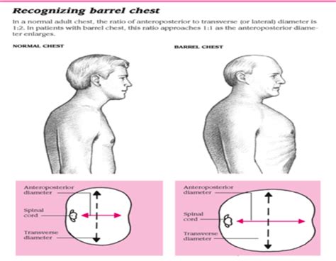 Obstructive airway disorders, Asthma, Pathogenesis, COPD, Barrel chest ...