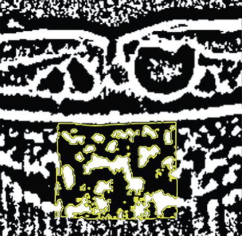 The Morphological Features Evaluated In Optical Coherence Tomography