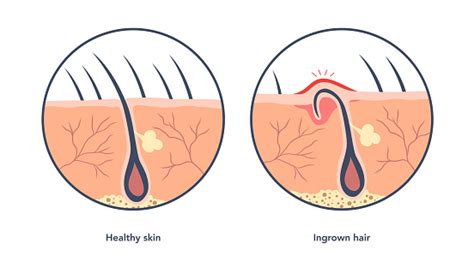 Ingrown Hair Medical Scheme Under Microscope Stock Illustration Download Image Now Hair