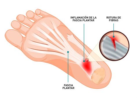 Fascitis plantar Aprende qué es síntomas y tratamiento Clínica