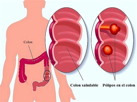 Polipos En El Colon Doctor Luis Javier C Rdenas