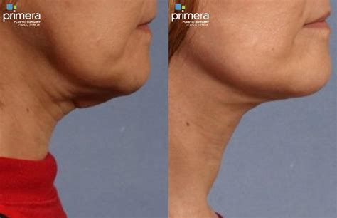 Neck Lift Before And After Photo Gallery Orlando Florida Primera Plastic Surgery