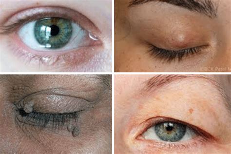 Chalazion Cyst In Eyelid Removal Surgery Optimal Vision