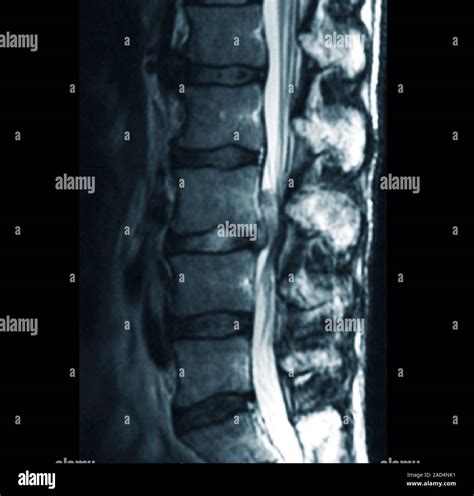 Slipped Disc Magnetic Resonance Imaging Scan Of A Sagittal Section