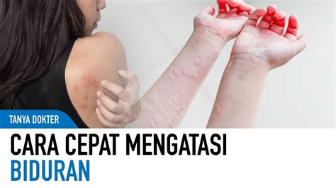 Cara Cepat Mengatasi Biduran Dirumah Dari Dokter Kulit Kata Dokter