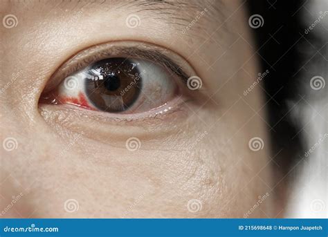 Broken Blood Vessels Subconjunctival Hemorrhage Broken Capillaries In