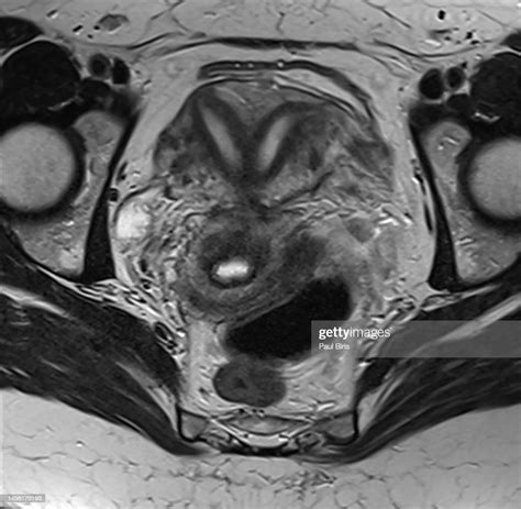 Imaging Of Congenital Uterine Anomalies Bicornuate Uterus High Res