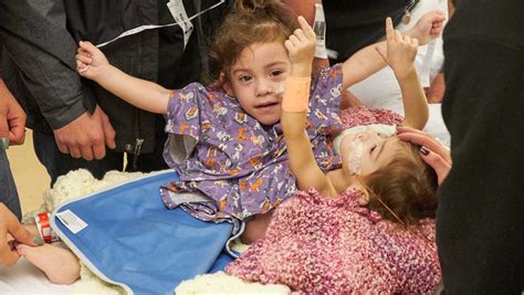 From 1 to 2: Conjoined twins recover from surgery