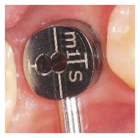 Stages Of Fabrication Of A Permanent Prosthesis After The Formation Of