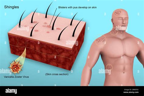 Diagrama Médico Que Muestra La Culebrilla Causada Por El Virus De La Varicela Zóster Fotografía