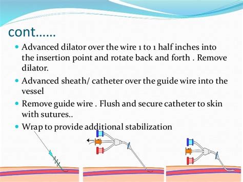 SELDINGER TECHNIQUE & INTERVENTIONAL RADIOLOGY