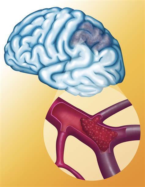 Information About Ischemic Stroke