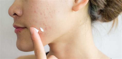 Hormonal Acne Treatment: Understanding Options for Your Skincare