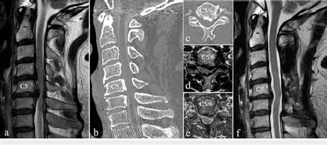 Preoperative Mri A D Ct B C And Postoperative Mri E F Of