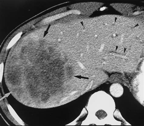 Radiologic Spectrum Of Cholangiocarcinoma Emphasis On Unusual