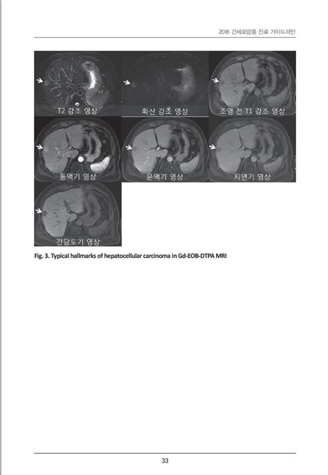 2018 간세포암종 진료 가이드라인 대한간암학회 국립암센터 네이버 블로그