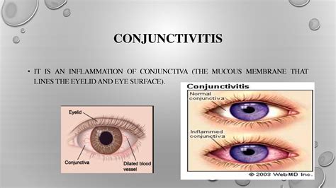 Solution Conjunctivitis Final Studypool