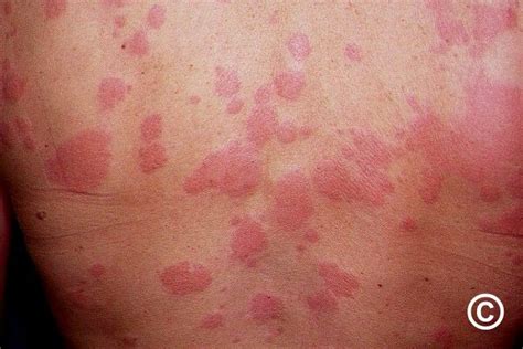 Spontaneous Urticaria Chronic Ordinary Urticaria