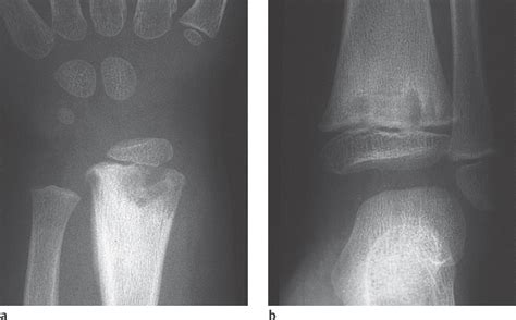 Osteomyelitis Radiopaedia