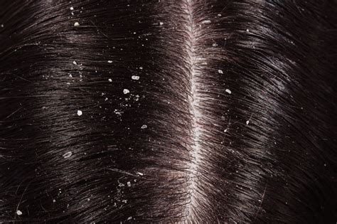 Does Dandruff Lead To Hair Fall Malay Mehta Aesthetic Clinic