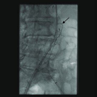 PDF A Simplified Method Of Pre Emptive Perigraft Aortic Sac