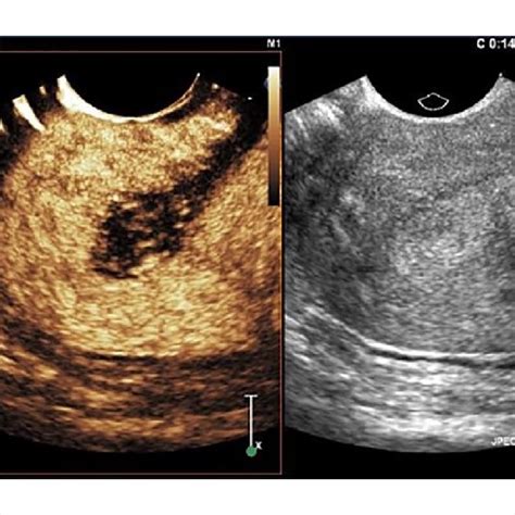 Diagnostic Accuracy Of Contrast Enhanced Ultrasound Ceus With