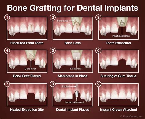 Bone Grafting for Dental Implants | Dental Innovations | Mark D ...