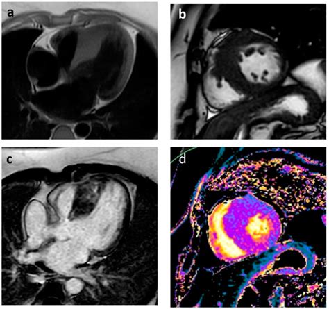 Jcm Free Full Text Arrhythmic Risk Stratification Among Patients