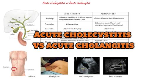 Acute Cholecystitis Vs Acute Cholangitis Youtube