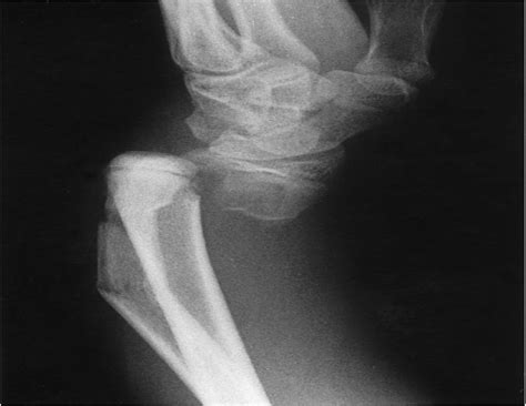 Late Extensor Pollicis Longus Rupture Following Displaced Di