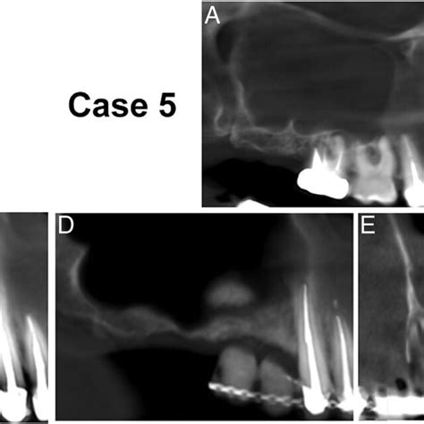 CBCT Scans Of Cases 5 And 6 A And B Case 5 A Full Obstruction