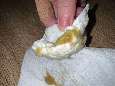 mucus  stool  attached rmedicaladvice