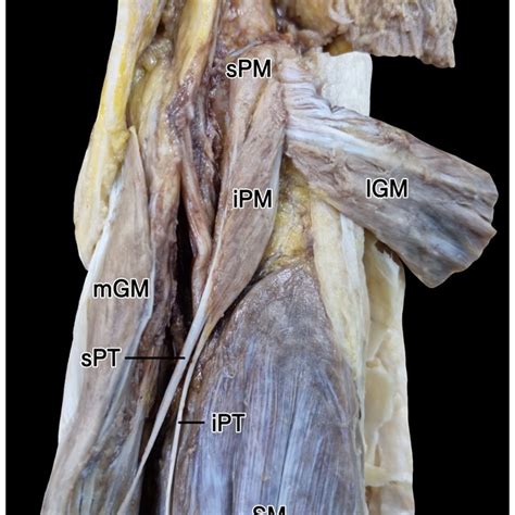 Bicipital Origin And The Course Of The Plantaris Muscle Posterior View