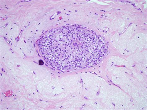 Breast Ductal Carcinoma In Situ Article