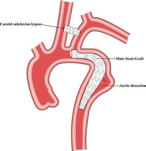 Schematic Representation Of Carotid Subclavian Bypass And Thoracic Download Scientific Diagram