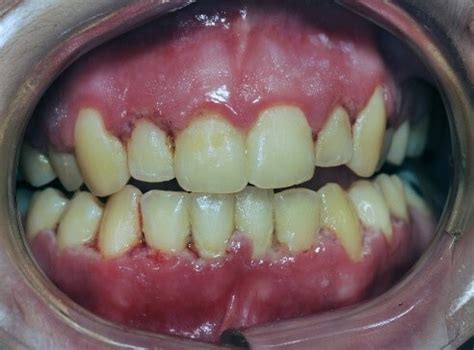 Figure Patient With Necrotizing Ulcerative Gingivitis Nug