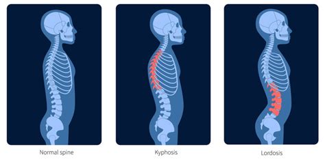 Lordosis Longhorn Brain And Spine