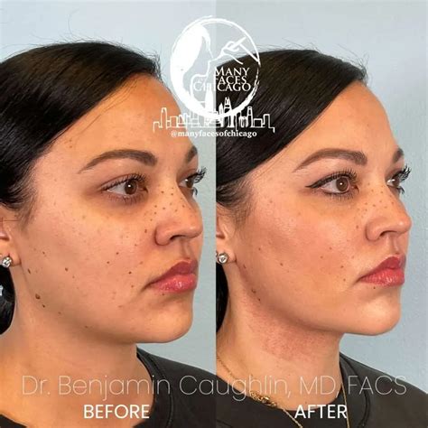 Facebbl Fat Transfer Treatment To Sculpt Your Face And Jawline