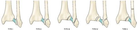 Patterns Of Anterior Inferior Tibiofibular Ligament Avulsion Fracture