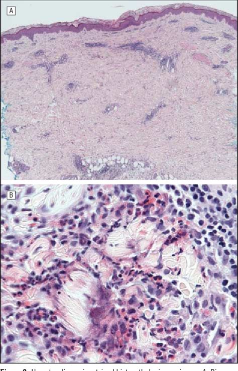 Figure 2 From Treatment Of Recalcitrant Eosinophilic Cellulitis With Adalimumab Semantic Scholar