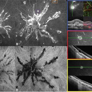 Ultra Widefield Color And Green Fundus Autofluorescence Faf Imaging