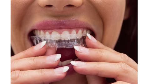 What To Expect During Your First Invisalign Consultation In Tampa