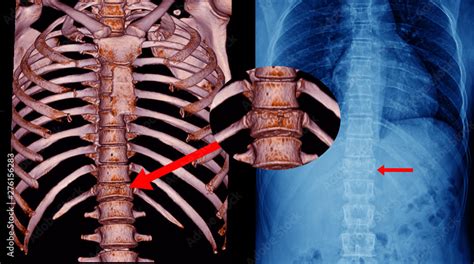 Ct Scan Thoracic Spine D And X Ray Thoracic Spine Finding Fracture T