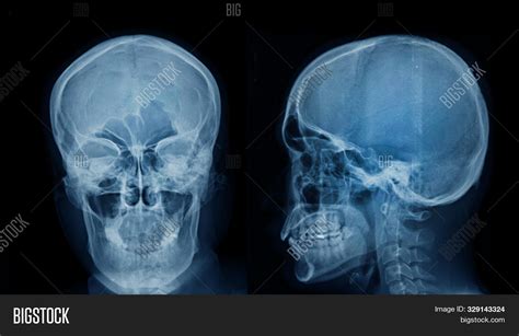 Head X Ray Ap Lateral Image And Photo Free Trial Bigstock